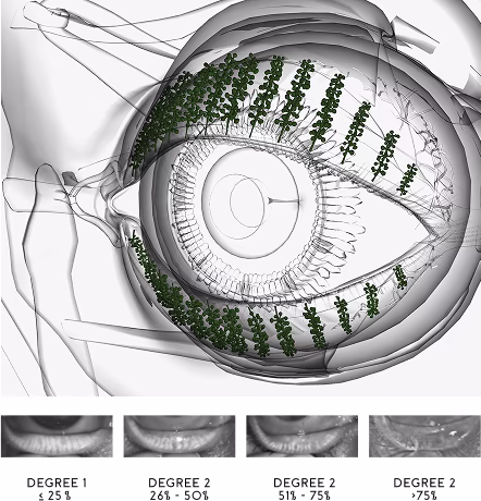 Ejemplo de Glándulas de Meibomio