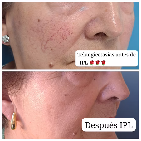 Antes y después del tratamiento de la Rosácea